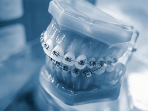 6 claves para elegir la técnica de ortodoncia ideal
