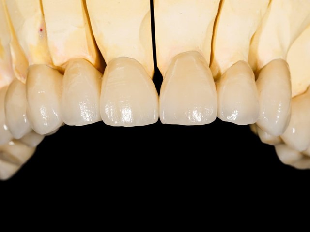 Fabricación de prótesis dentales en Narón