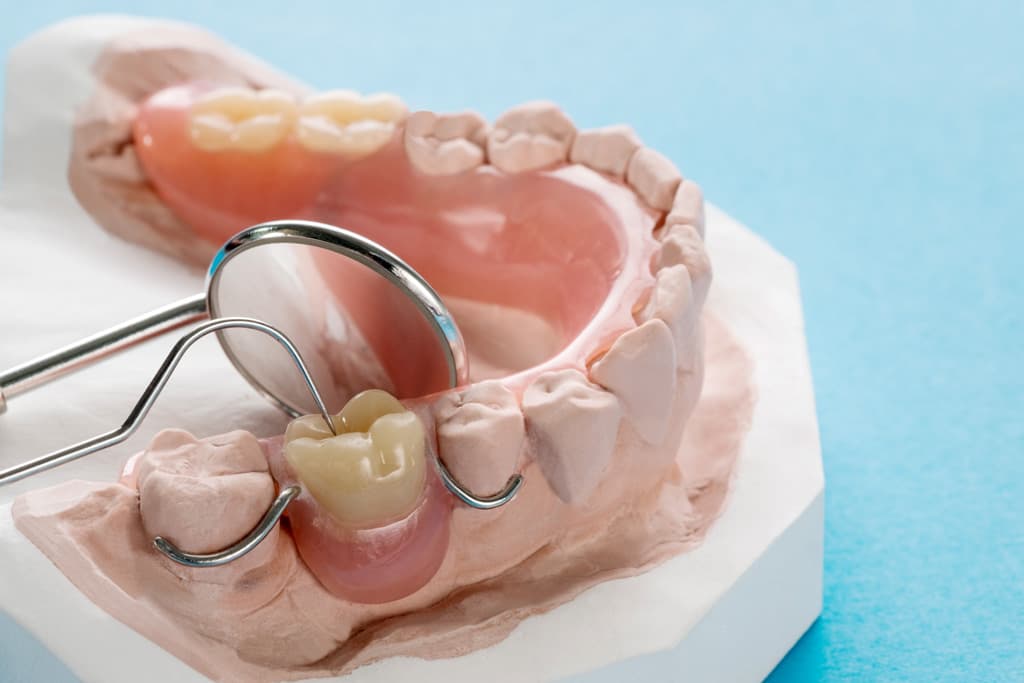 Diseño de esqueléticos dentales en Narón