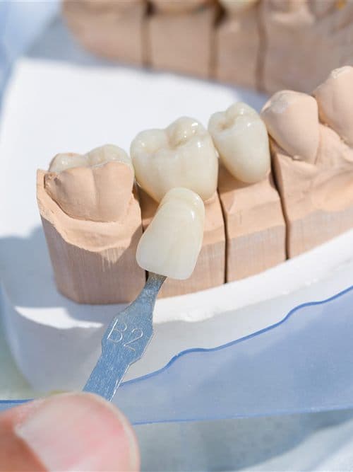 Diseño de prótesis dentales fijas en Narón - Trasancos