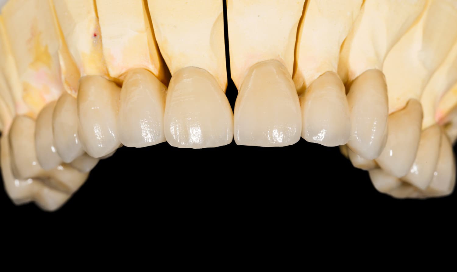 Protésis fija odontología en Narón