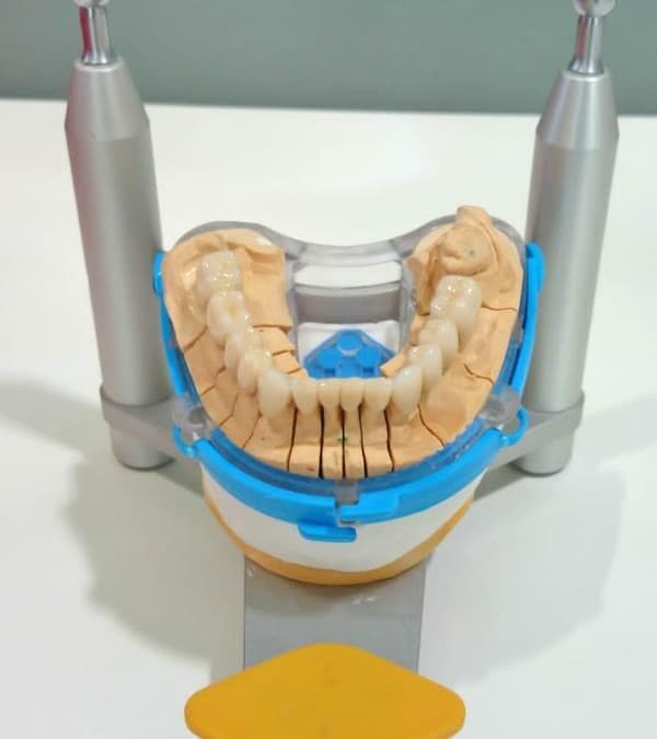 Las diferencias entre las sobredentaduras y las dentaduras postizas convencionales