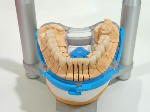 Las diferencias entre las sobredentaduras y las dentaduras postizas convencionales