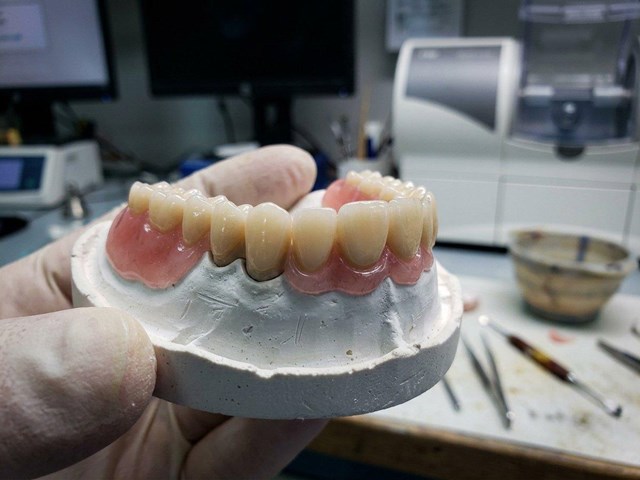 Más precisión y menos ajustes: prótesis móviles de circonio con CAD-CAM en Valdoviño