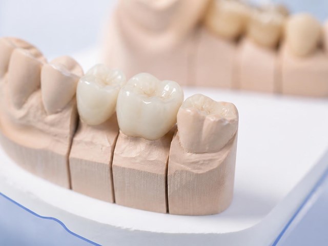 Prótesis fijas de circonio con ajuste natural en Ares
