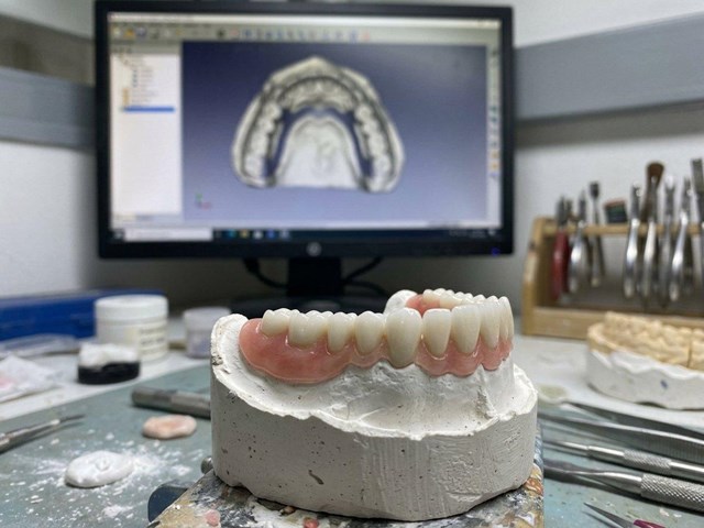 Solución rápida tras la pérdida dental: prótesis móviles de circonio en Cedeira