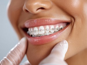 Soluciones ortodónticas personalizadas: la clave para tratamientos exitosos en tu clínica