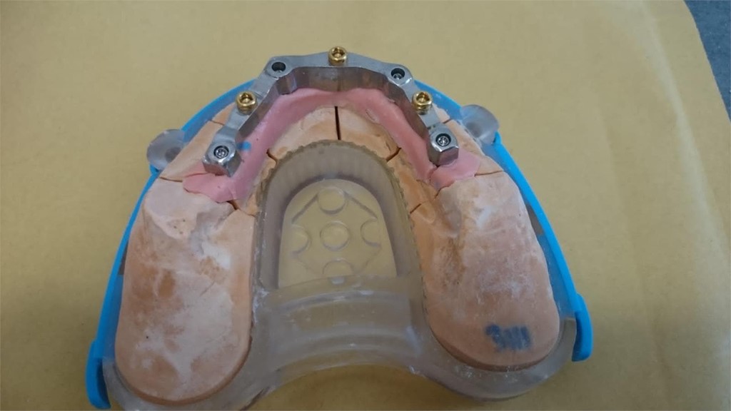 Trabajo sobre implantes