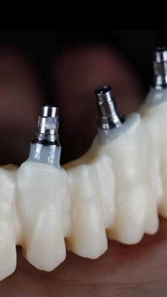 Trabajos de implantes