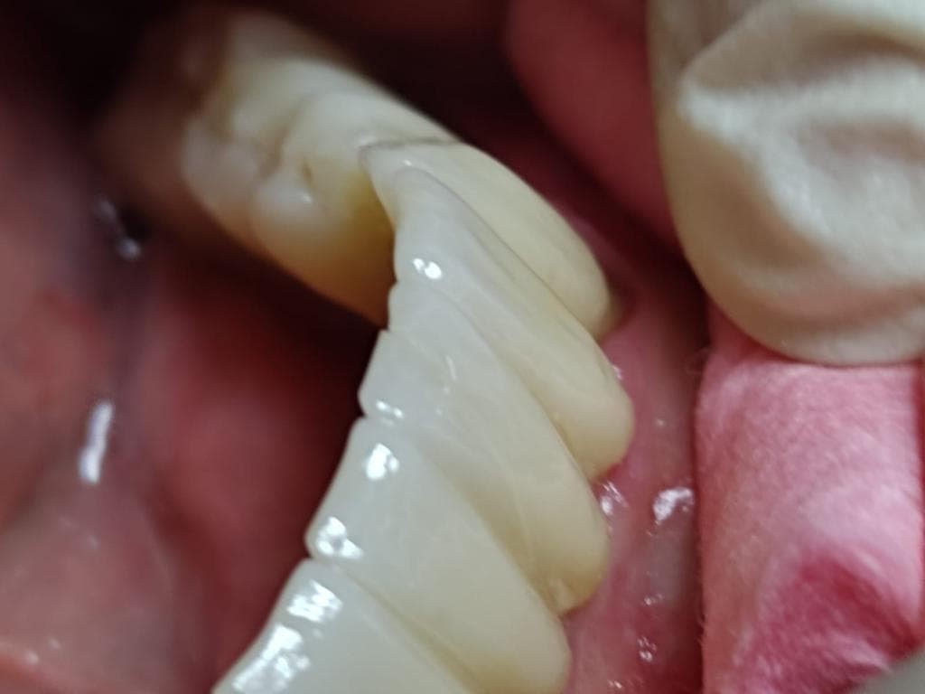 Trabajos realizados en zirconio